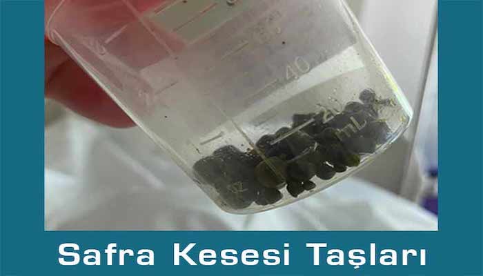 Safra Kesesi Ameliyatı